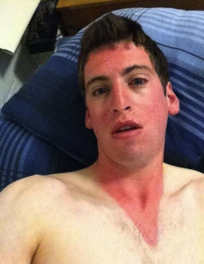 33 People Who Got Seriously Sunburned.