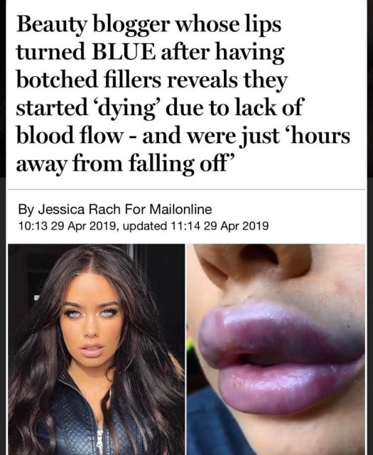 lip - Beauty blogger whose lips turned Blue after having botched fillers reveals they started dying' due to lack of blood flow and were just 'hours away from falling off By Jessica Rach For Mailonline , updated