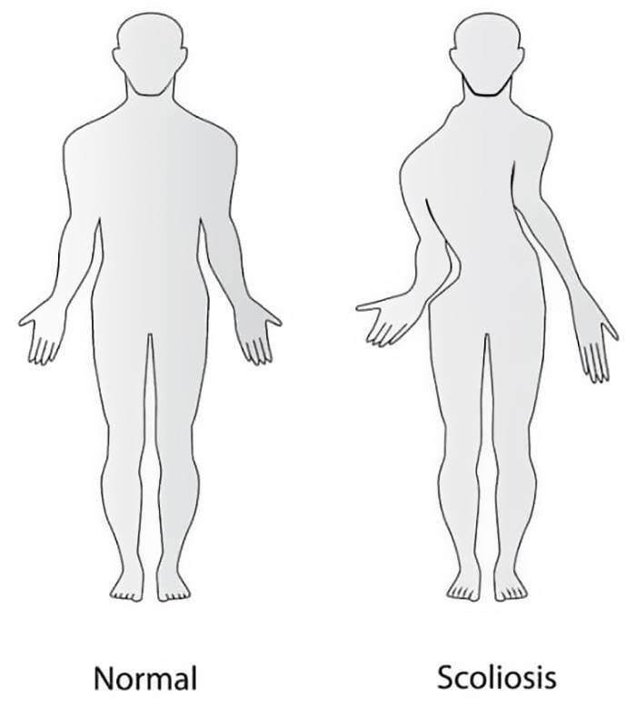 scoliosis legs - Normal Scoliosis