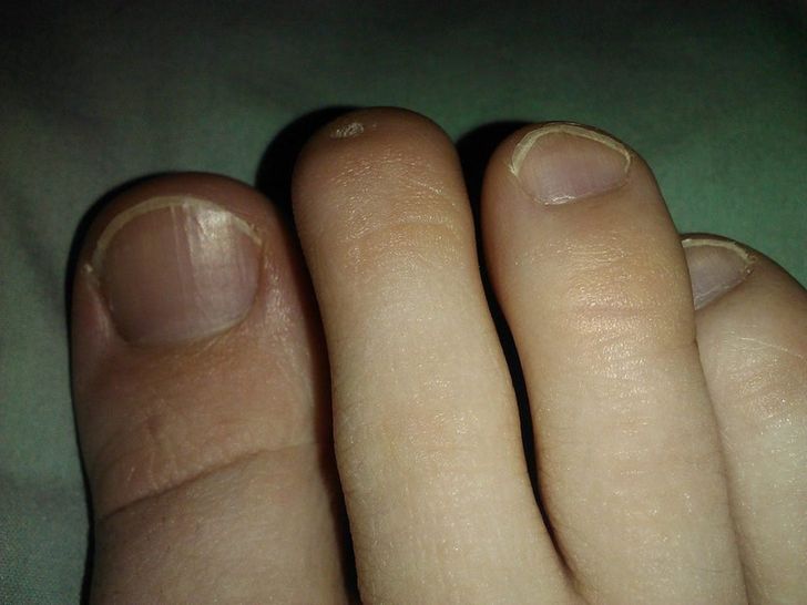 little toe nail