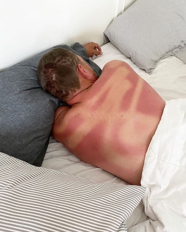 wife messed up applying sunscreen to husband's back