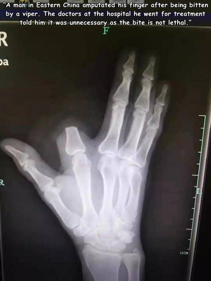 man cuts off finger after snake bite - "A man in Eastern China amputated his finger after being bitten by a viper. The doctors at the hospital he went for treatment told him it was unnecessary as the bite is not lethal." F R R 12CM