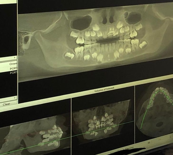 Dental 3D X-ray on a child whose teeth haven’t grown in yet