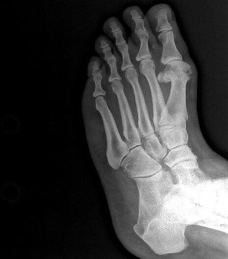 “An x-ray of a bunion on my left foot”