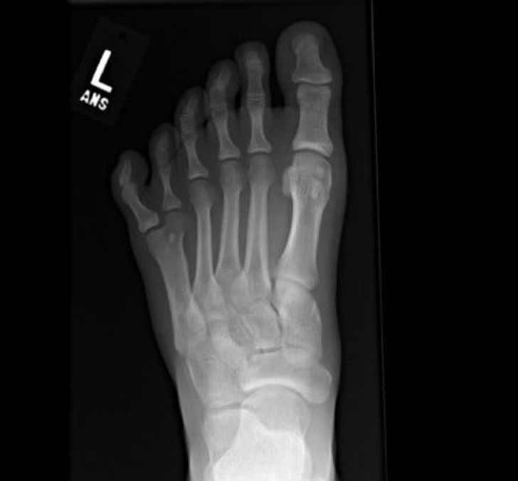 “I have 6 toes on my left foot (known as hexadactyly). Here’s the X-ray.”