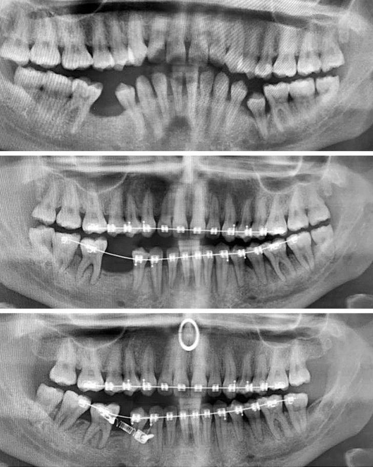 “My X-rays before braces in August 2018 to now August 2020”