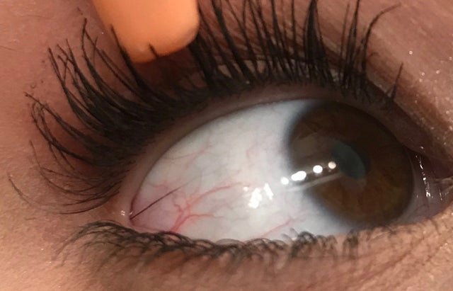 eye with needle stuck in it