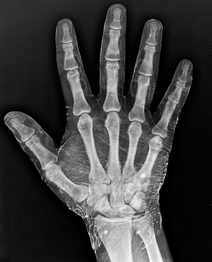 x ray of a hand dipped in iodine