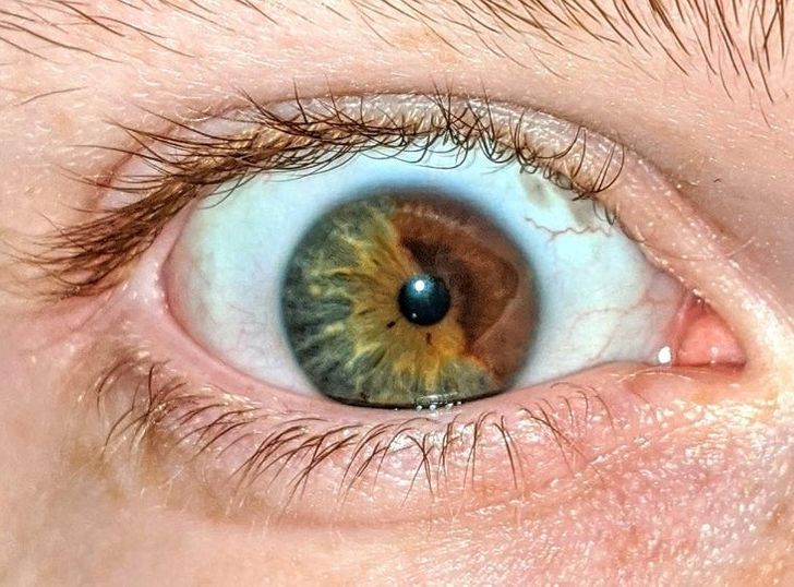 “A mildly interesting photo of my eye that I managed to get in focus — I have sectoral heterochromia.”