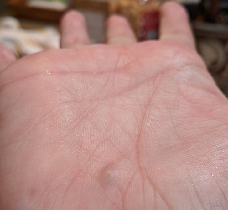 “A rock working its way out of my hand after a bicycle accident over 25 years ago”