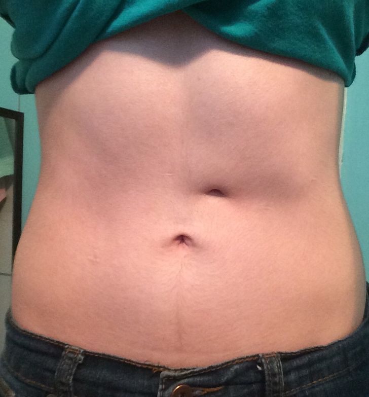 “I have cystic fibrosis. One of my scars looks like a second belly button.”