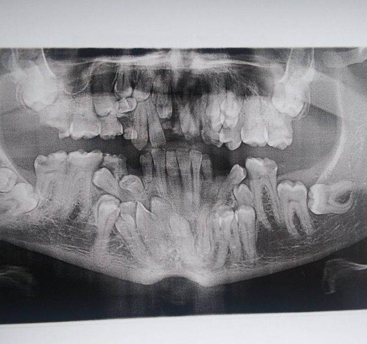 “I have a rare disorder called cleidocranial dysostosis. Got my first dental X-ray today and I have a lot of extra teeth.”