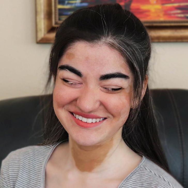 “My vitiligo has turned half of my upper eyelashes white.”