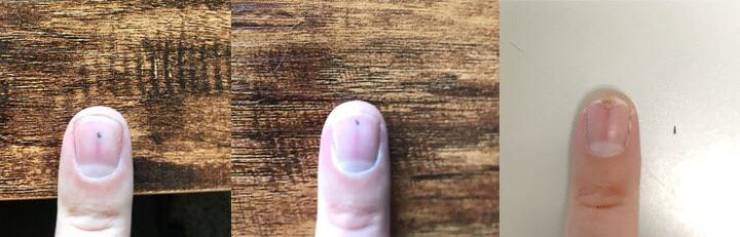 “The thorn that’s been traveling through my fingernail since July 18 completed its journey today.”