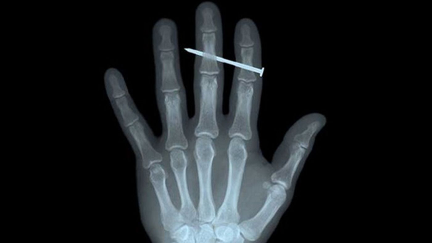 x ray of hand