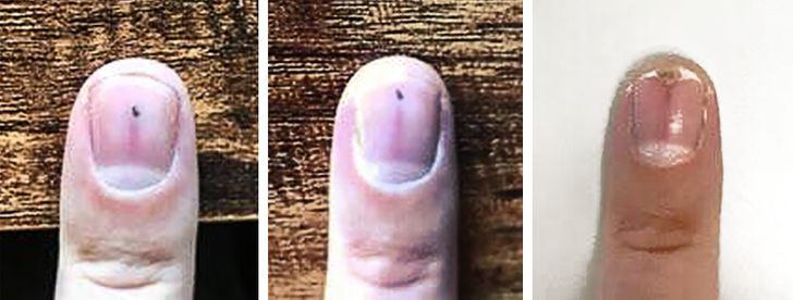 “The thorn that’s been traveling through my fingernail since July 18 completed its journey today.”