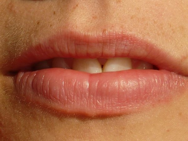 Philtrum:
The vertical groove between the nose and upper lip