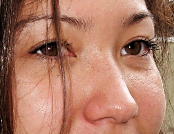 Glabella:
The space between the eyebrows