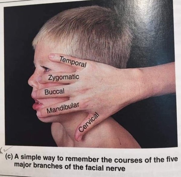 facial nerve branches - Temporal Zygomatic Buccal Mandibular Cervical c A simple way to remember the courses of the five major branches of the facial nerve