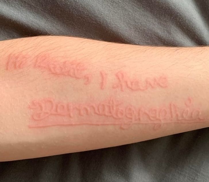 "I have dermatographia.”