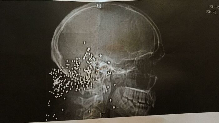 A Rather “Rural” Patient Came In With New-Onset Seizures. Ct Reveals Small Metal Pellets In Head. Patient States His Wife Accidentally Shot Him Several Years Ago While Trying To Get A Raccoon Off Their Property