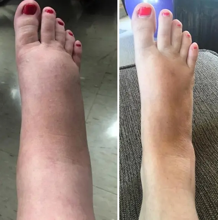 My Pregnancy Feet Versus My Normal Feet