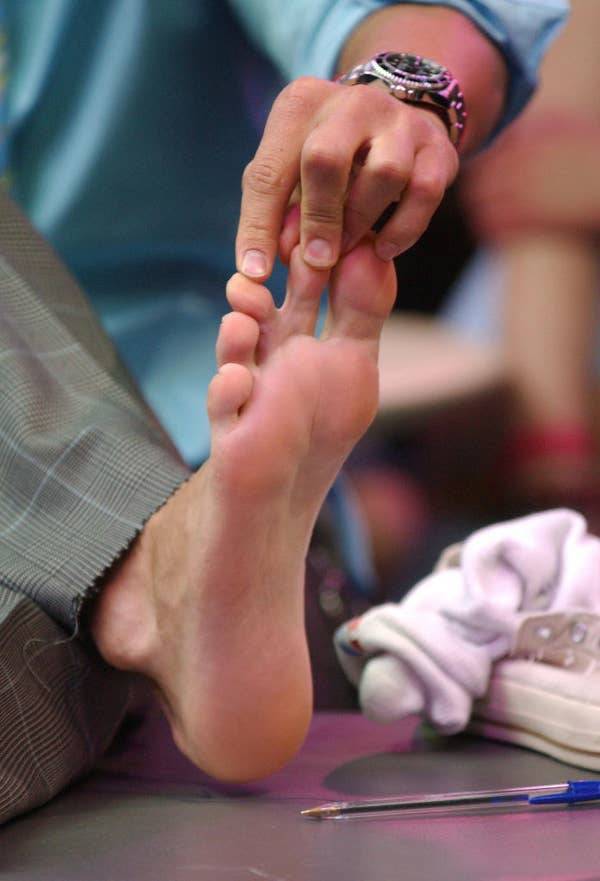 Ashton Kutcher has webbed toes.