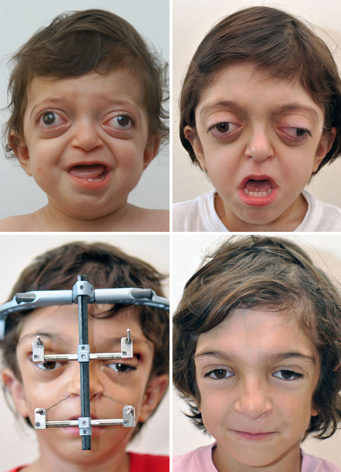 wholesome pics - boy with deformity gets plastic surgery to help him