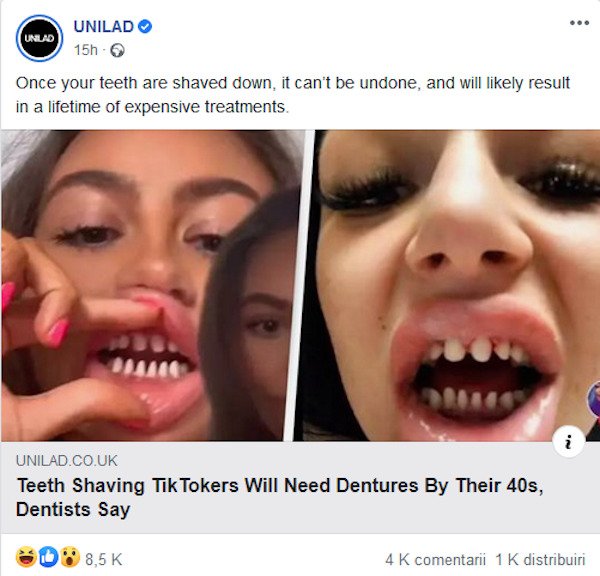 tiktok teeth shaving - Unilad Unilad 15h Once your teeth are shaved down, it can't be undone and will ly result in a lifetime of expensive treatments. Unilad.Co.Uk Teeth Shaving Tik Tokers Will Need Dentures By Their 40s, Dentists Say 4K comentarii 1 K di