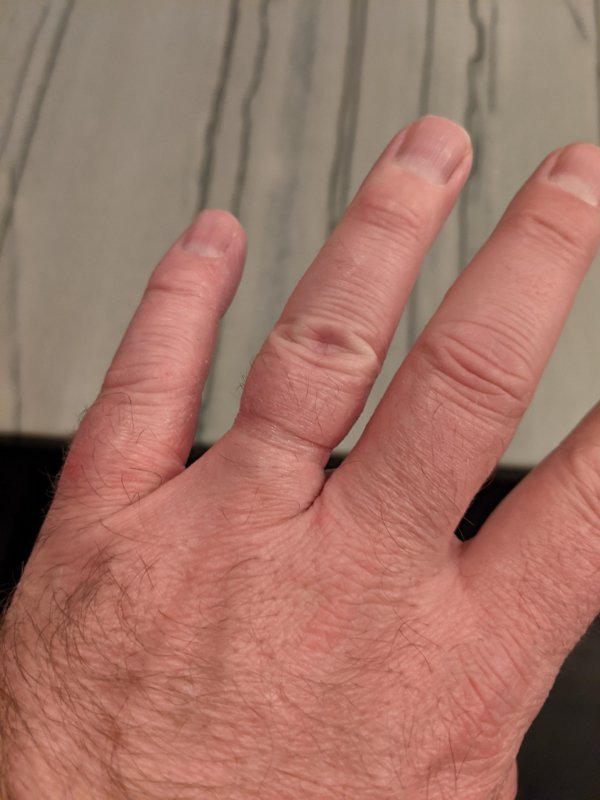 “My wedding ring was a little tight when we got it 20 years ago, finally had to cut it off today. (We are still happily married)”