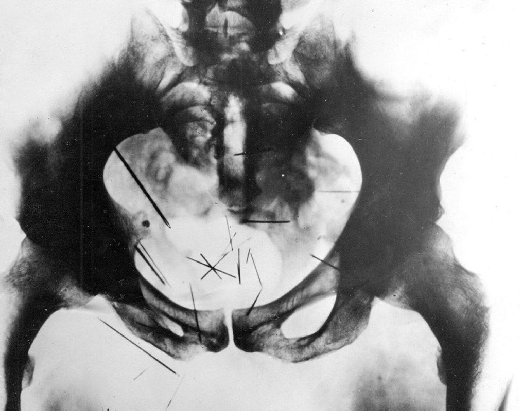 X-Ray of serial killer Albert Fish’s pelvis. Taken in 1935 after his arrest, it revealed at least 29 self-embedded needles in his pelvic region and was used as defence evidence at his trial.