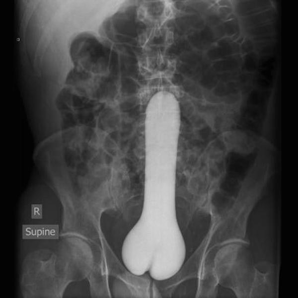 x ray sex - R Supine