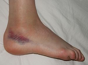 sprained ankle