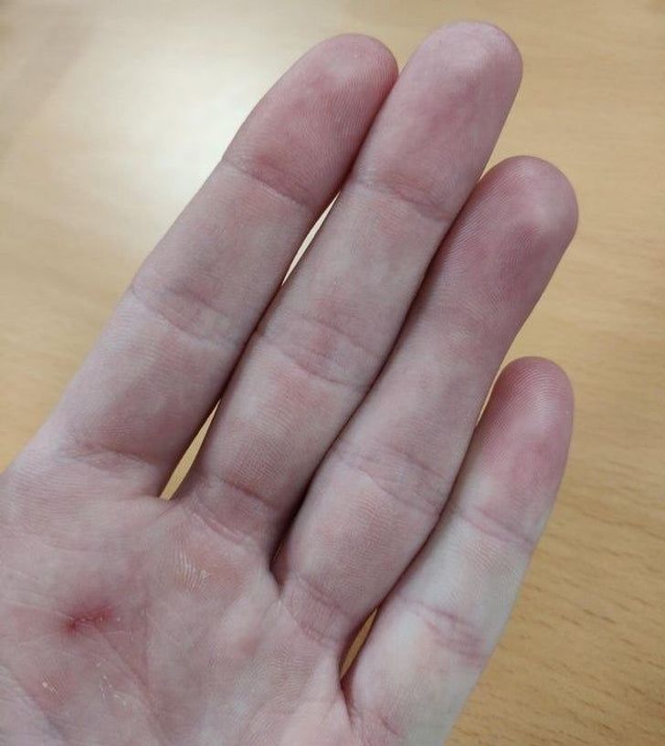 “I lost the crease on my ring finger after not bending it for 10 years due to an injury.”