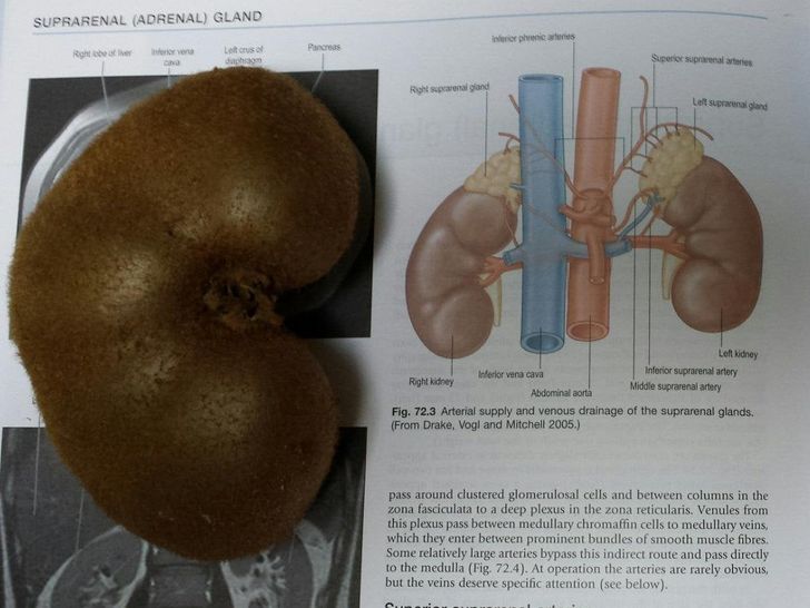 Suprarenal Adrenal Gland inferior phras Lotus Pancreas Superior suprarenale Rightspraand Lo suprarenal gland Gla Lelkidney Inferior suprarenal artery Interior vena cava Right kidney Middle suprarenal artery Abdominal aorta Fig. 72.3 Arterial supply and…