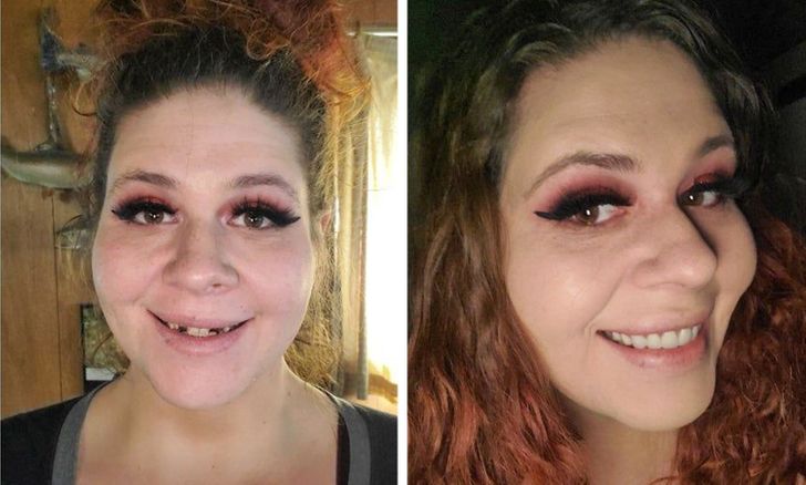 “For years, I ignored my dental and mental health. I can finally look at myself when I talk and smile in photos. The work is hard but worth it.”