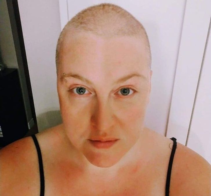 “I was losing my hair due to anxiety and it made me feel sad and powerless. Then I decided not to give up and buzzed it all off. Here’s my first hairless picture. Hair or no hair, I’m still worthy of happiness.”