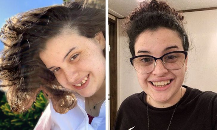 “16 years ago, I had a tooth injury and suffered through countless surgeries and pain. Thanks to the hard work of a single mother, I finally have a worthy smile again.”