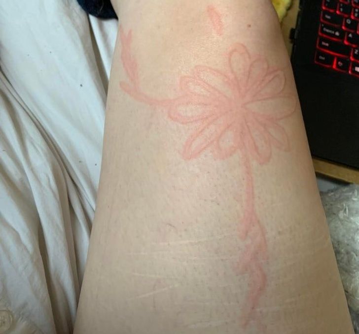 “I have a skin condition that causes my skin to raise from the smallest scratch. I like to draw flowers on myself!”