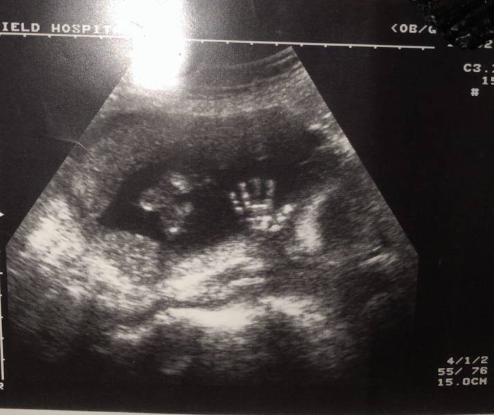 cool pics - ultrasound sonogram baby hand waving