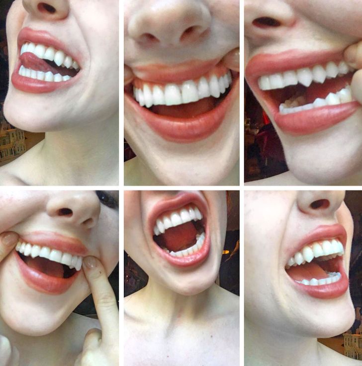 This girl’s real teeth could easily be mistaken for a vampire’s.