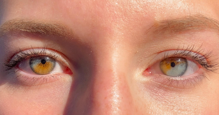 “I have partial heterochromia in both eyes.”