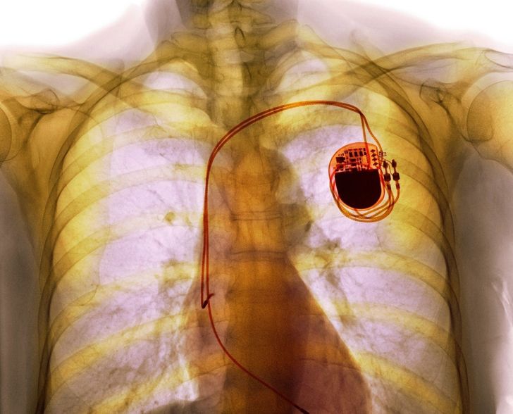An ordinary pacemaker looks like something from a different world.