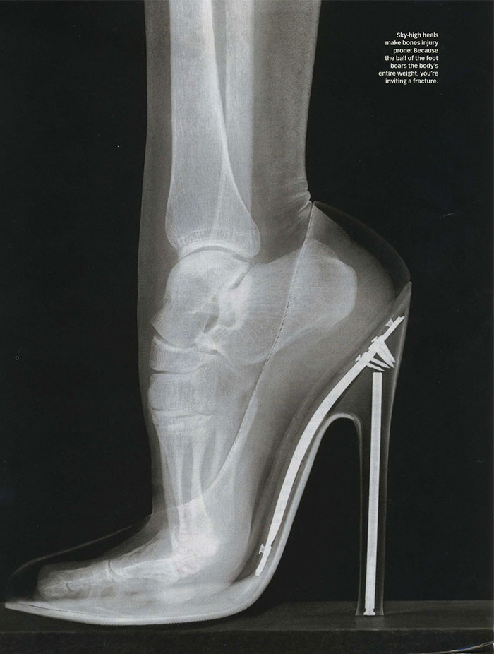 x ray high heels - Skyhigh heels make bones injury prone Because the ball of the foot bears the body's entire weight, you're inviting a fracture.