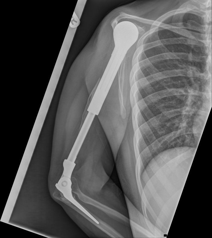 metal arm x ray