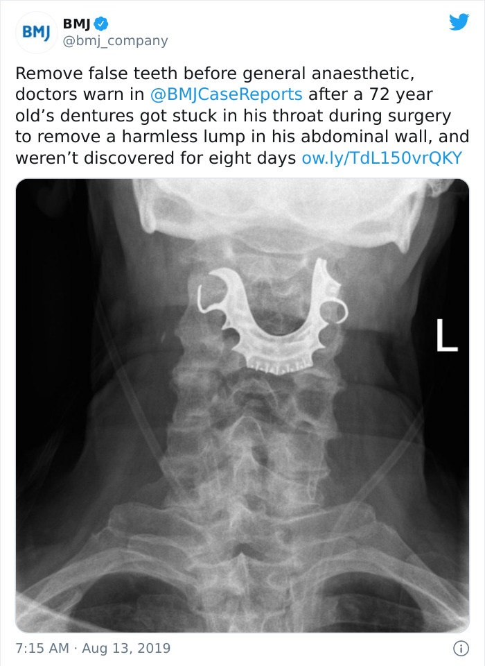 dentures stuck in his throat - Bmj Bmj Remove false teeth before general anaesthetic, doctors warn in after a 72 year old's dentures got stuck in his throat during surgery to remove a harmless lump in his abdominal wall, and weren't discovered for eight d