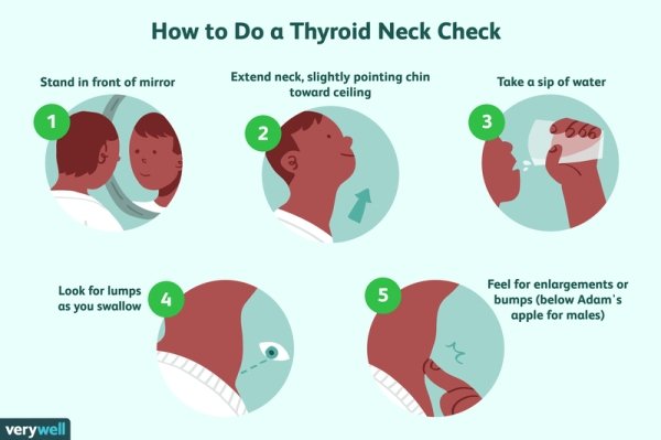 normal neck vs goiter - How to Do a Thyroid Neck Check Stand in front of mirror Extend neck, slightly pointing chin toward ceiling Take a sip of water 1 3 2 666 Look for lumps as you swallow 4 5 Feel for enlargements or bumps below Adam's apple for males 