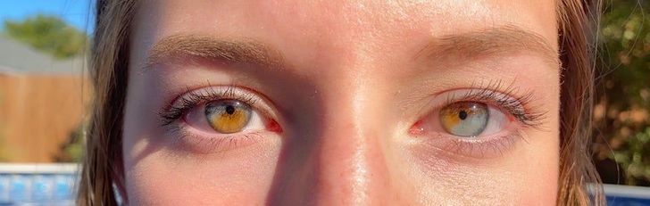 “I have partial heterochromia in both eyes.”
