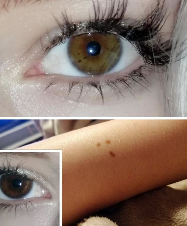 “I have matching triangle freckles on my arm and my left eye.”
