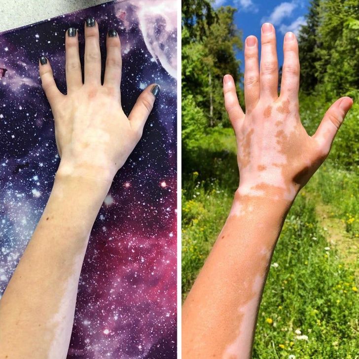 “How my vitiligo changes from the winter to the summer”